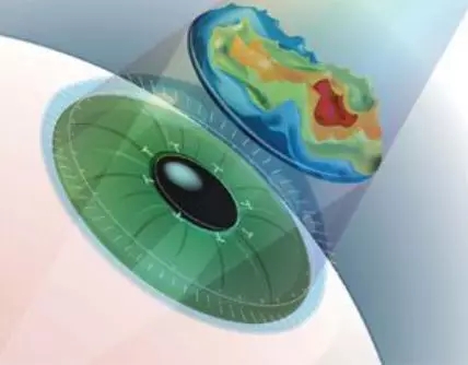 激光近視矯正和ICL晶體植入近視矯正攻略，